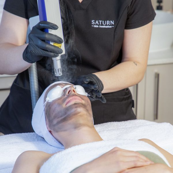 Carbon Laser Facial