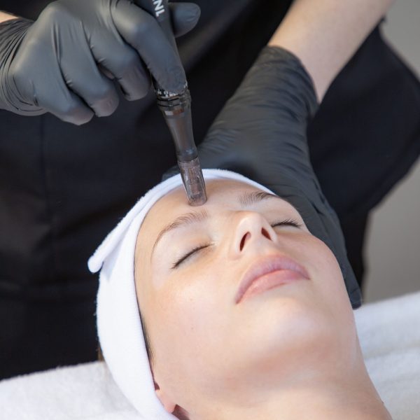 1Need Microneedling